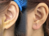 GIẢI PHÁP GIẢM MỠ THON GỌN AN TOÀN TẠI YẾN NHI BEAUTY CENTER