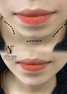 GIÚP BẠN ĐẸP HƠN TỪNG ĐƯỜNG NÉT TẠI YẾN NHI BEAUTY CENTER
