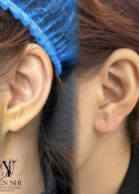 GIẢI PHÁP GIẢM MỠ THON GỌN AN TOÀN TẠI YẾN NHI BEAUTY CENTER