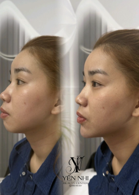 GIẢI PHÁP XÓA NHĂN, THON GỌN MẶT AN TOÀN TẠI YẾN NHI BEAUTY CENTER