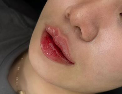 Filler Hàn Vip