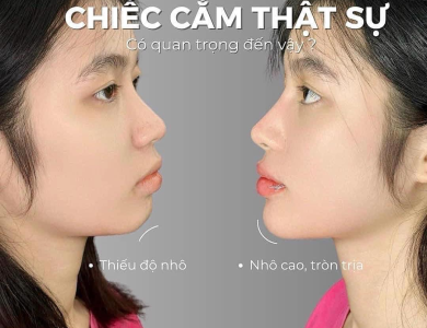 Filler Hàn Vip