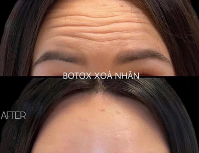 Xoá nhăn 