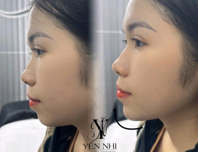 Filler Hàn Vip