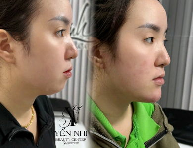 Filler Hàn Vip
