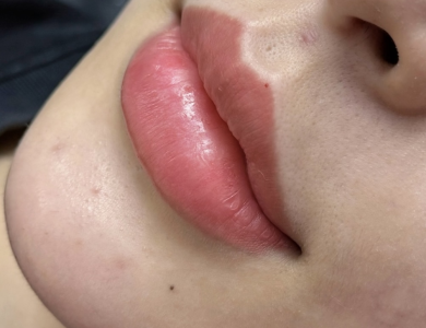 Filler Hàn Vip