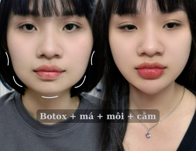 Filler Hàn