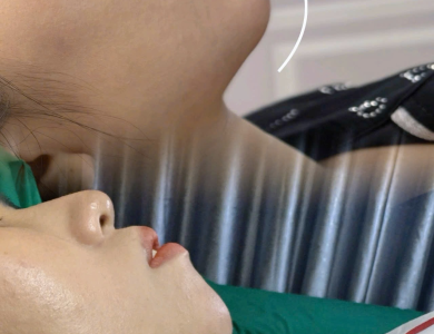 F.Juvederm