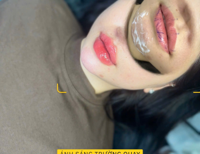 F.Juvederm