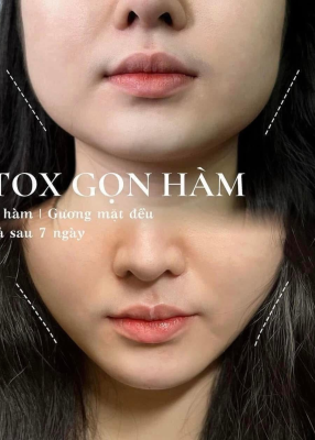 Botox Mỹ 