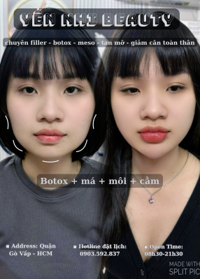 Botox Hàn Vip 