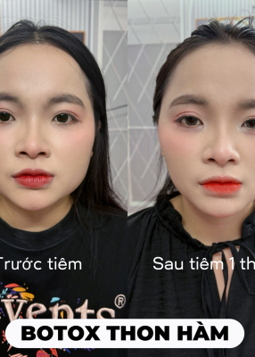 Botox hàm Hàn 