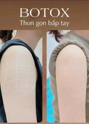 Botox bắp tay, chân 