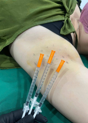 Ức chế tuyến hôi 